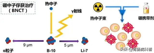 Bnct硼中子治疗肿瘤2025最新消息——国内研发与应用进展 